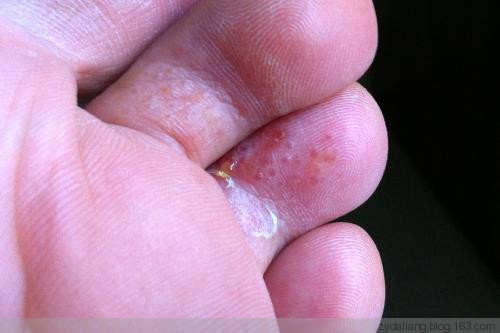 腳氣原來這樣就可以簡單消失 - 瀛子 - 瀛の小箋